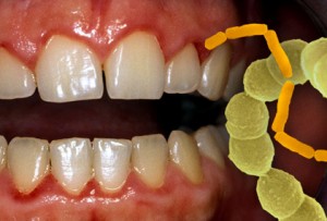 Gum Disease Periodontist