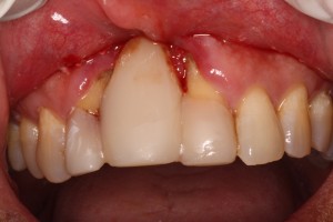 Dental Implants Complex Case