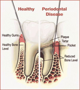 Gum Disease