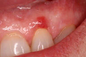 Gum Infection Pre Op 