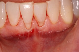 Gum Recession Pre-Op