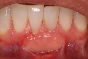 Gum Recession 6 wk Post-Op