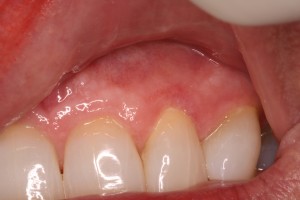 Gum infection Post Op