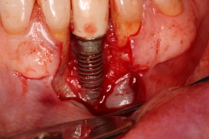 Bone loss around a Dental Implant