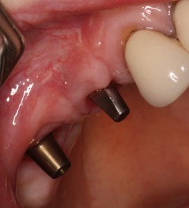 Dental Implants Pre Restorations
