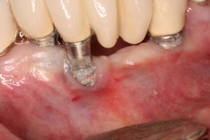 Bone loss around dental implants.