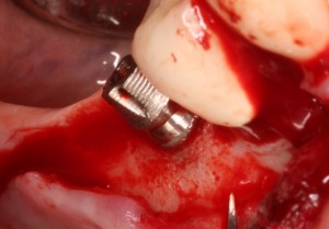 Dental implant / improper placement