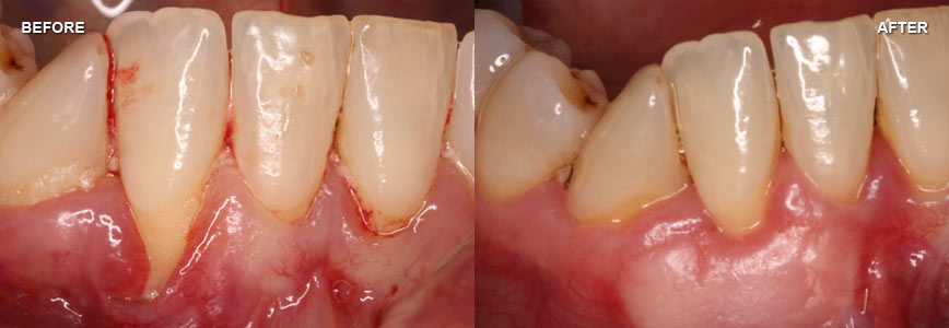 Soft Tissue Grafting