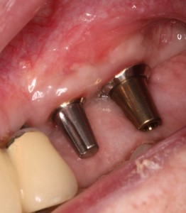 Dental implants with abutments.