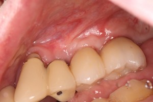Completed Dental Implant Restorations