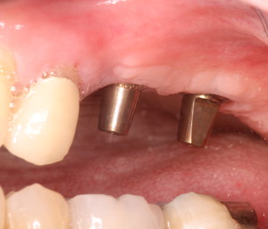 Unrestored dental implants