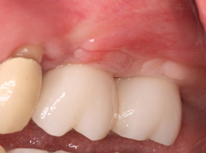 Dental implants with final restorations cemented.