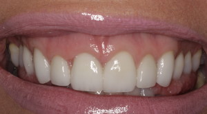 Excess Gingival Display