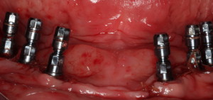 Mandibular Dental Implants