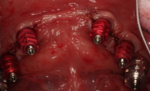 Occlusal View / Dental Implants