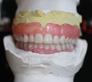 Dental Implants / Lab Casts