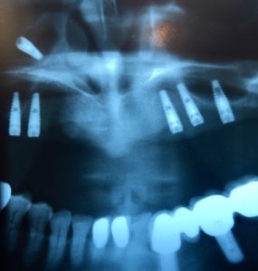 Dental Implant Discovered in Maxillary Sinus.