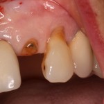 Patient with a broken front tooth