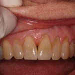 Recession before Alloderm allograft treatment