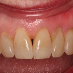 Gum recession treated with a Alloderm allograft