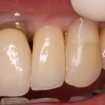 Single dental implant used to replace a broken tooth