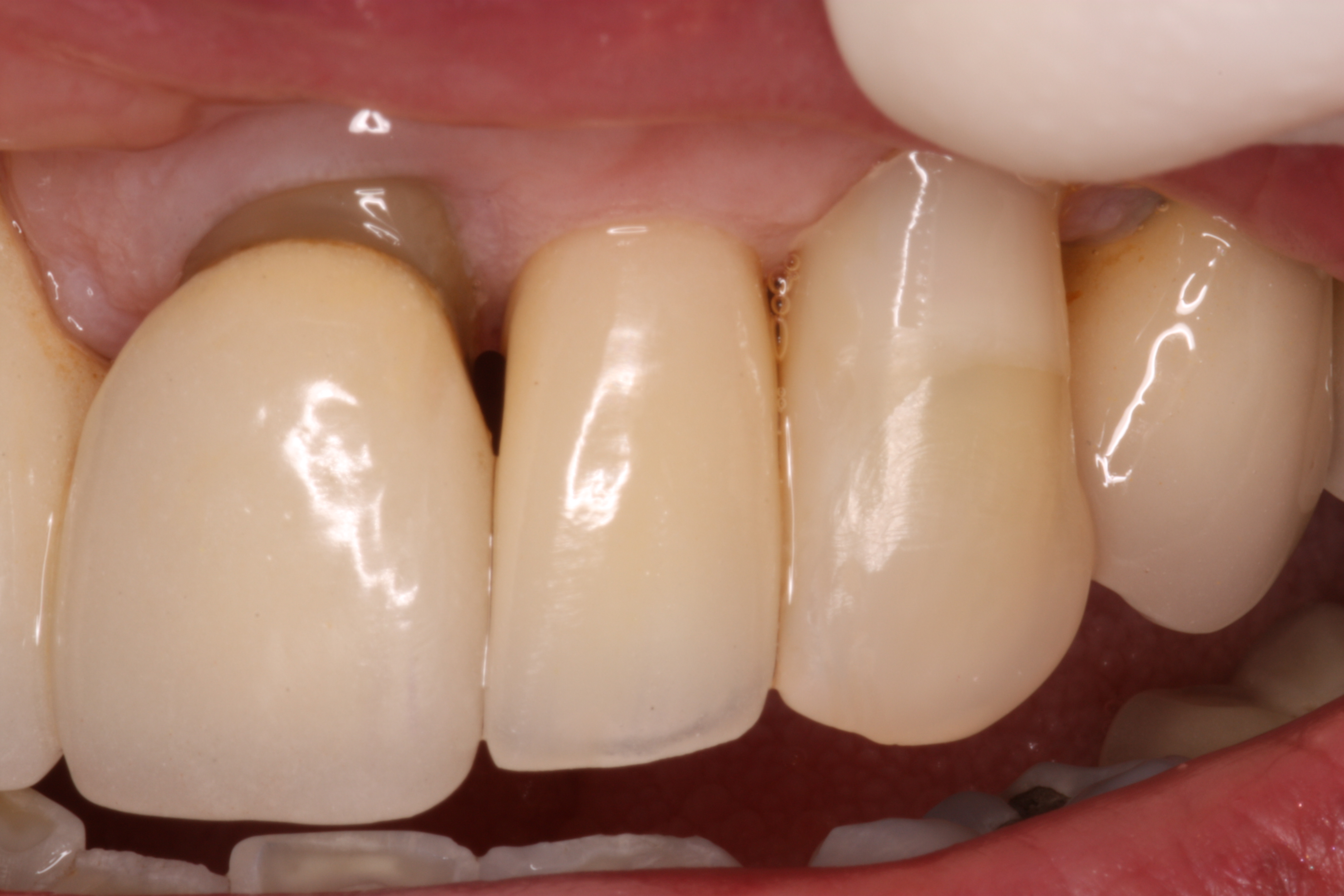 Single dental implant used to replace a broken tooth