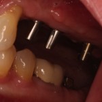 Multiple Dental Implants with Torqued Abutments