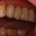 4 Dental Implants replacing 5 missing teeth