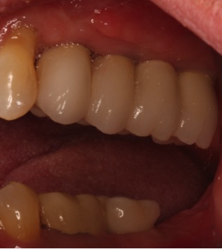 4 Dental Implants replacing 5 missing teeth