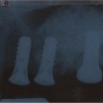 3 Dental Implants Placed In Regenerated Bone
