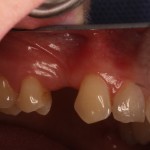 Missing tooth prior to dental implant placement
