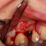 Dental implant placement with sinus bone graft