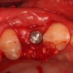 Surgical view of a dental implant placed within a bone graft