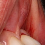 Before Frenectomy of High Frenum