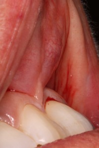 Before Frenectomy of High Frenum