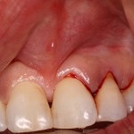 Before Frenectomy of High Frenum Attachment