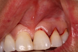 Before Frenectomy of High Frenum Attachment