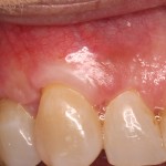 Correction of receding gums
