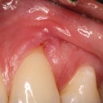 Dental emergency due dental floss injury