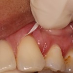 Dental emergency, example of dental floss injury