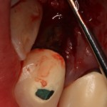 Example of a root surface with bacterial plaque and calculus (causes gum disease) before treatment