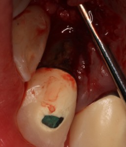 Example of a root surface with bacterial plaque and calculus (causes gum disease) before treatment