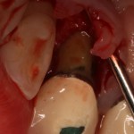 Example of a cleaned root surface without bacterial plaque or calculus (causes gum disease) post treatment