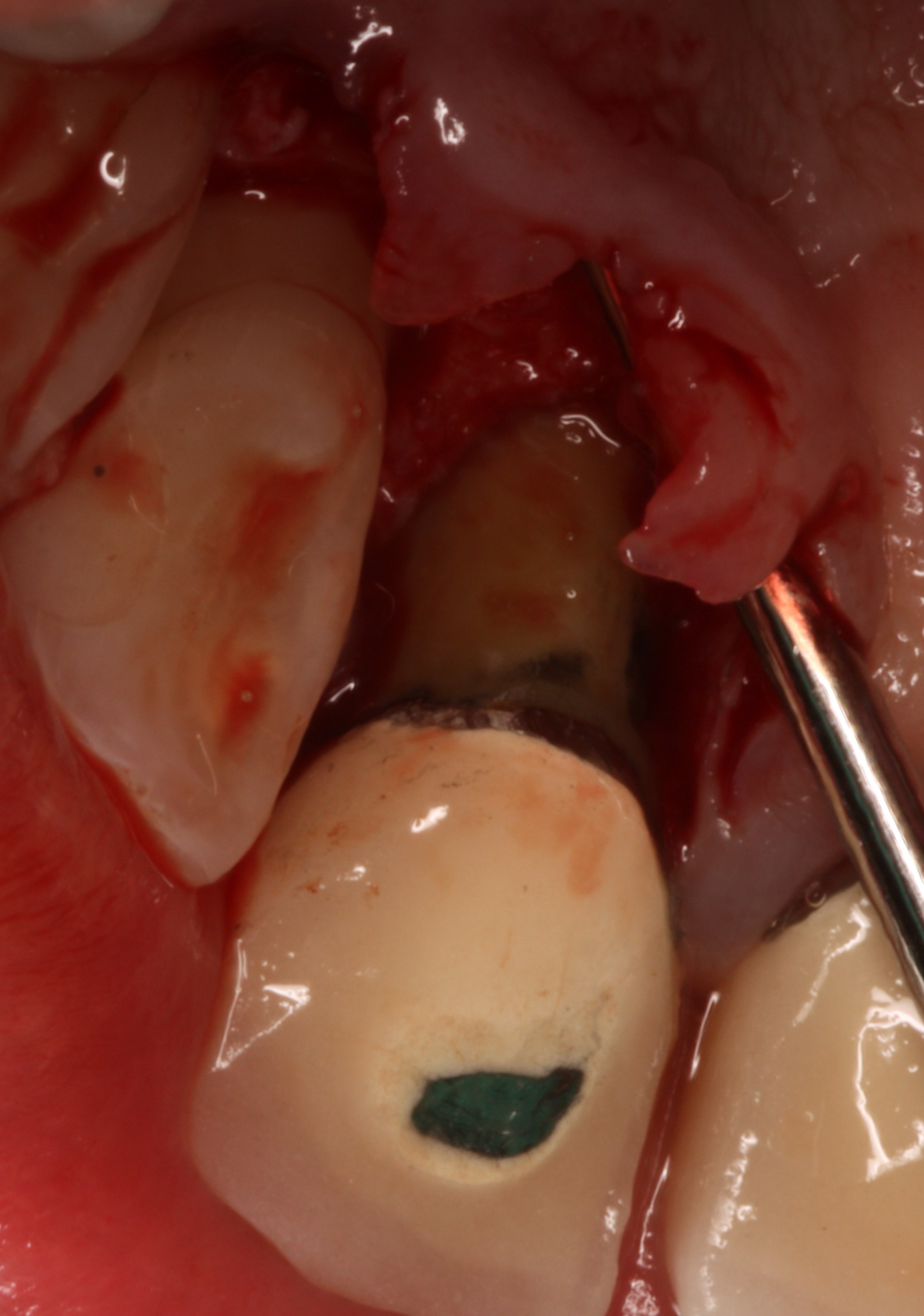 Example of a cleaned root surface without bacterial plaque or calculus (causes gum disease) post treatment