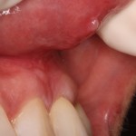 Side View Post Frenectomy of High Frenum Attachment