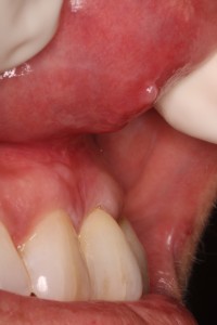 Side View Post Frenectomy of High Frenum Attachment