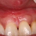 Front View Post Frenectomy of High Frenum Attachment