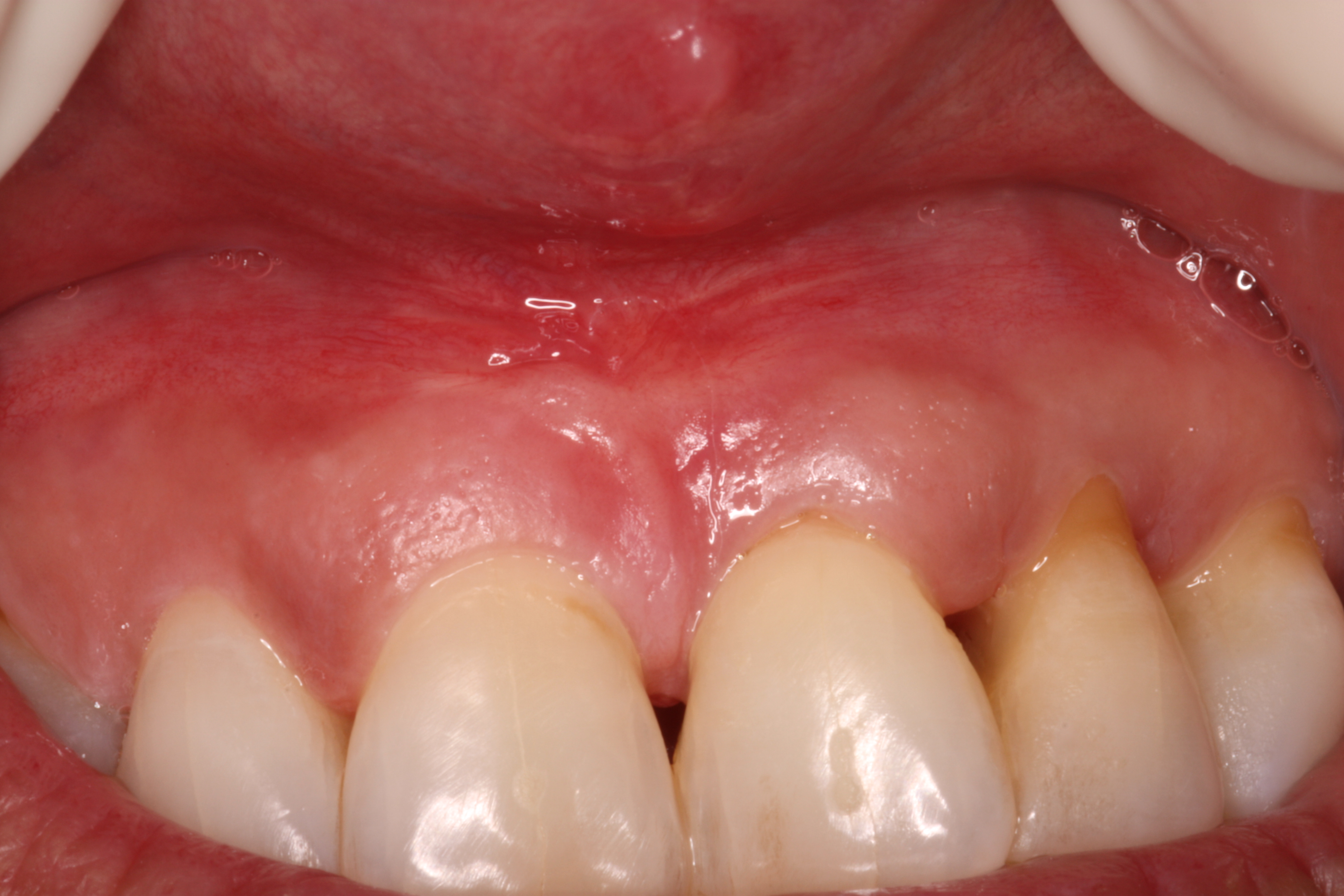 Front View Post Frenectomy of High Frenum Attachment