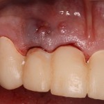 Temporary bridge before extractions / bone graft and subsequent dental implants
