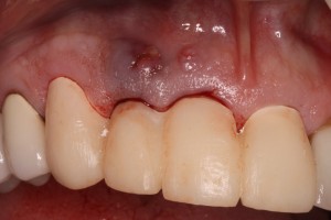 Temporary bridge before extractions / bone graft and subsequent dental implants